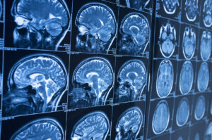 Overview of Brain Injuries